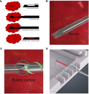 A retrospective comparative study on the diagnostic efficacy and the complications: between CassiII rotational core biopsy and core needle biopsy